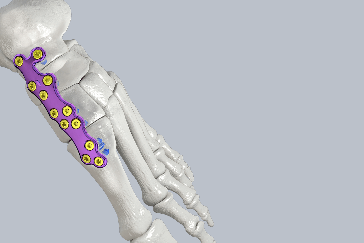 Midfoot Reconstruction System