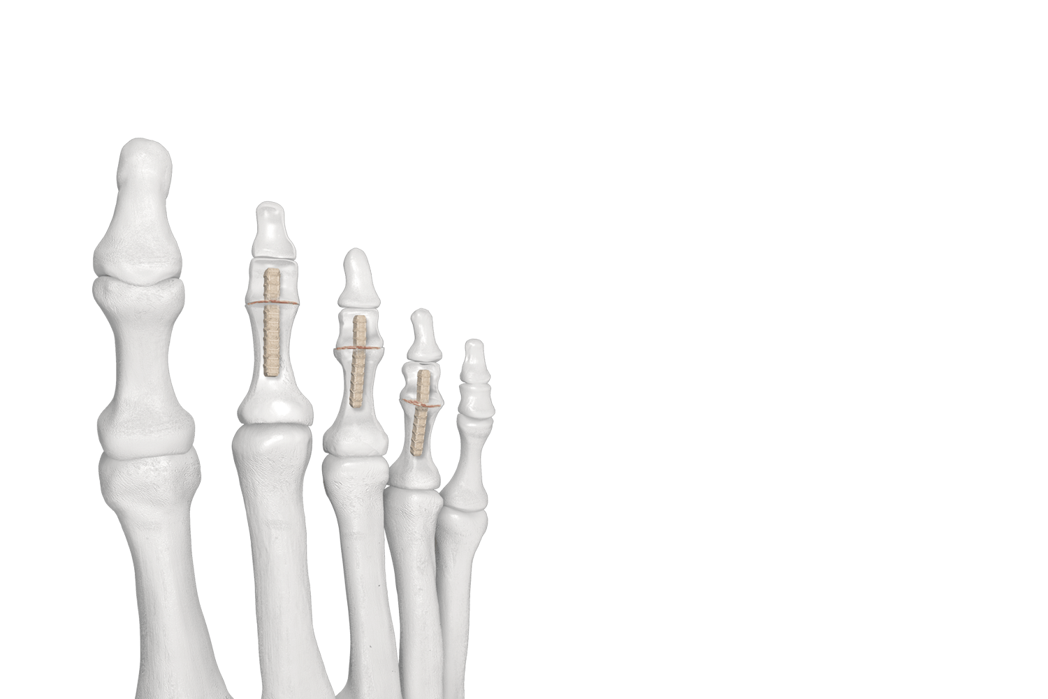 PRESERVE™ HammerGraft™ System