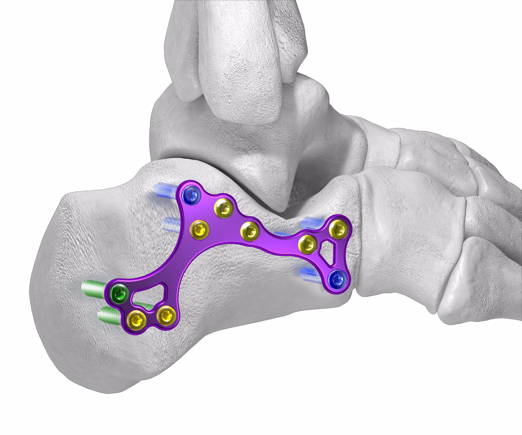 Gorilla® Calc Fracture Plating System