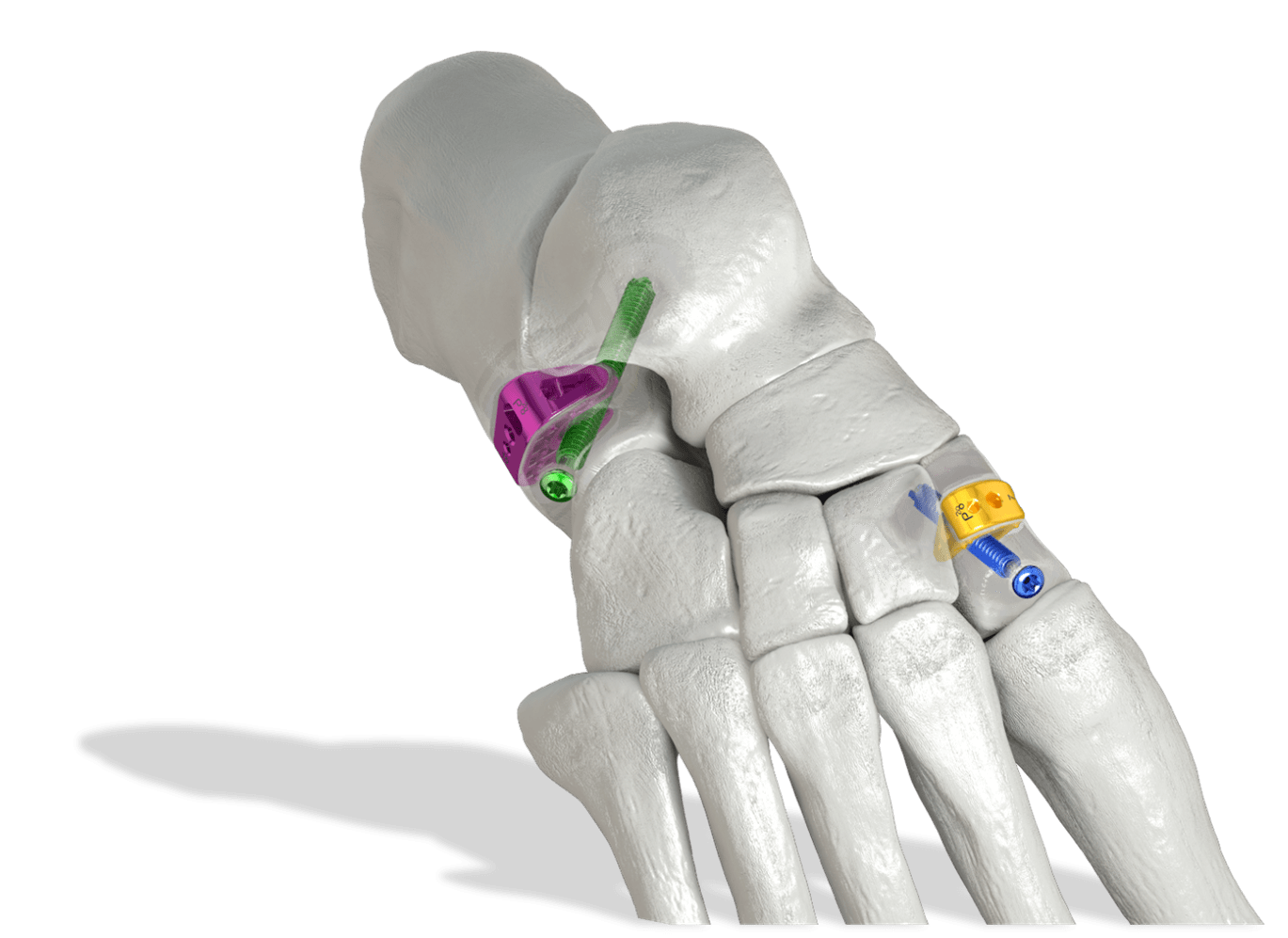 TITAN 3-D™ Wedge System