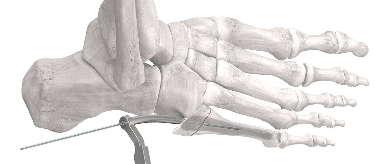 PRECISION® Jones Fracture Screw System