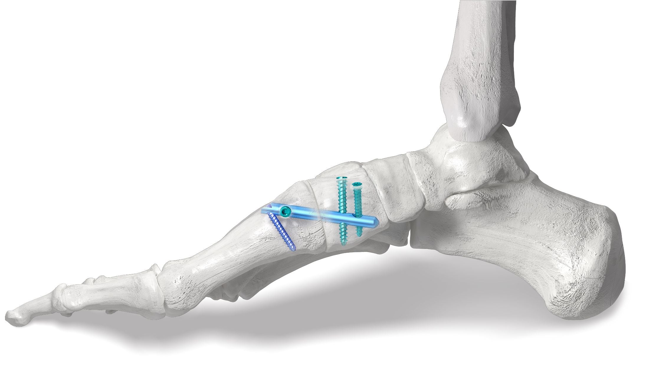 PHANTOM™ Lapidus Intramedullary Nail System