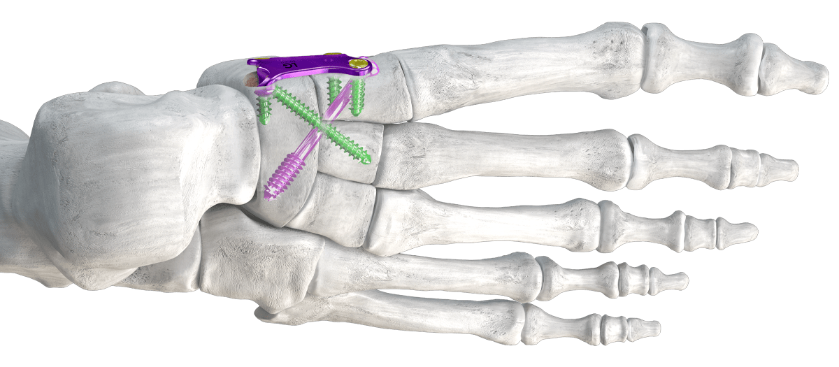Banner1NC Gorilla® NC Fusion Plating System