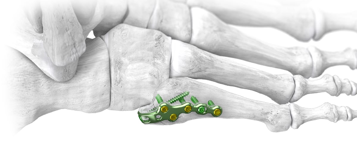 Website_Hero_Shot_5th_Met-1 Baby Gorilla™ 5th Metatarsal Hook Plates