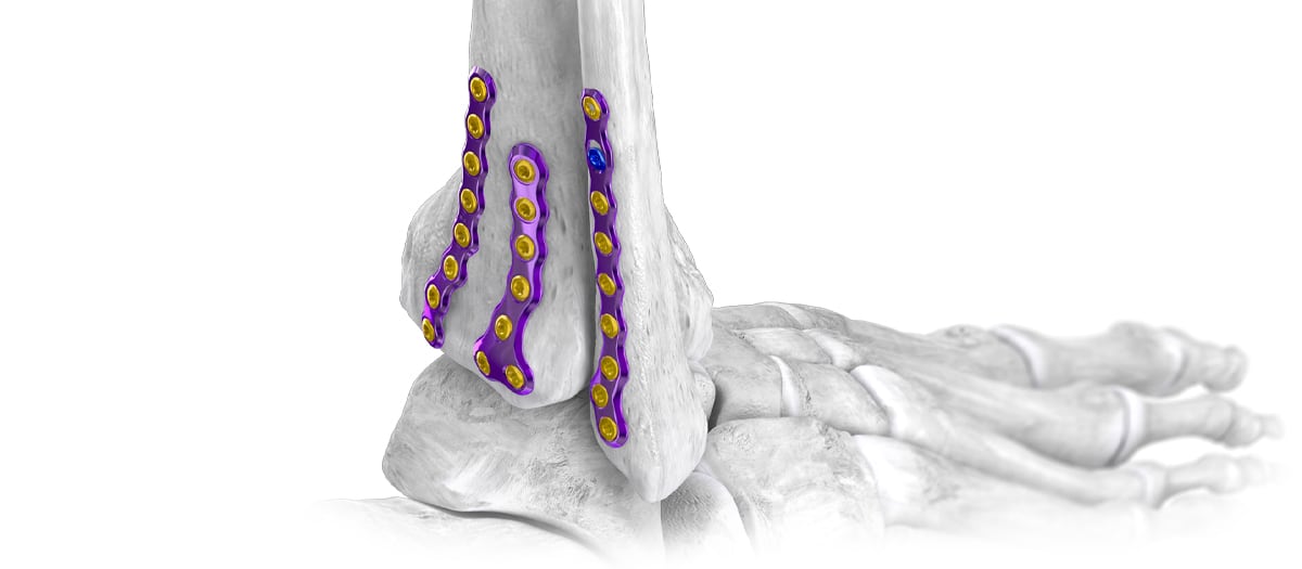 Website_Hero_Shot_AF_Plates Posterior Plating System