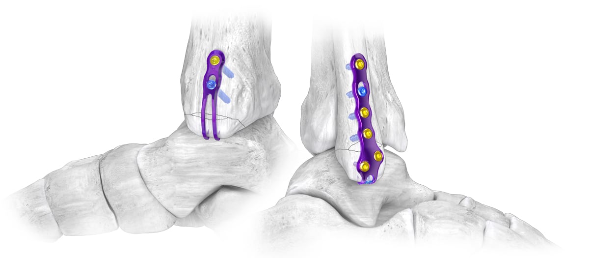 Website_Hero_Shot_AF_Hook Hook Plating System