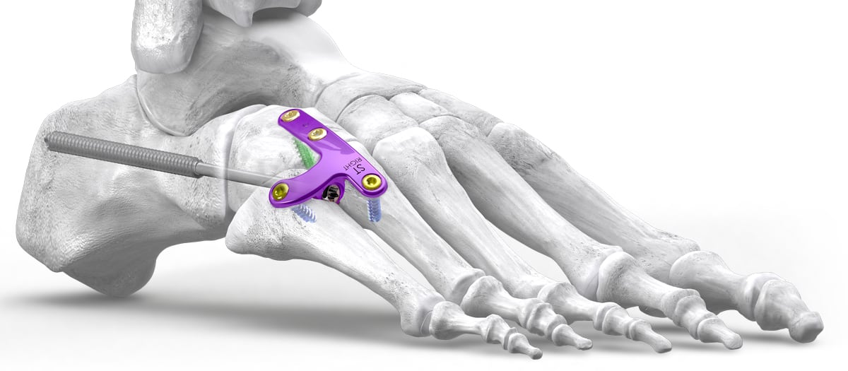 Gorilla® Lateral Column Plating System