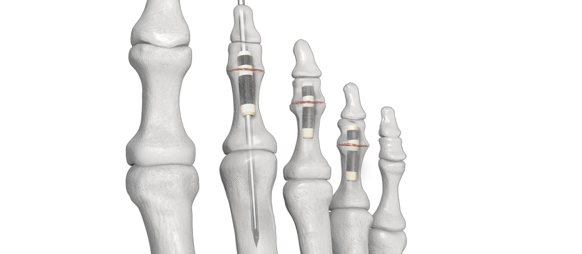 HammerTube™ System