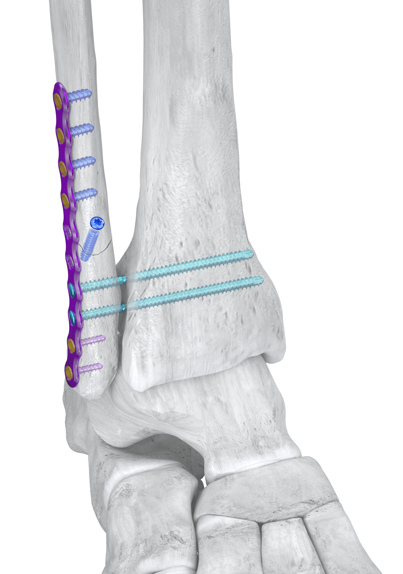 Syndesmosis_Screw_Inset syndesmotic repair solution