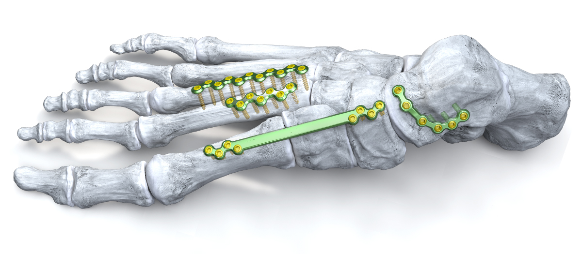 Baby Gorilla® Mini Plating System Baby Gorilla® Mini Plating System