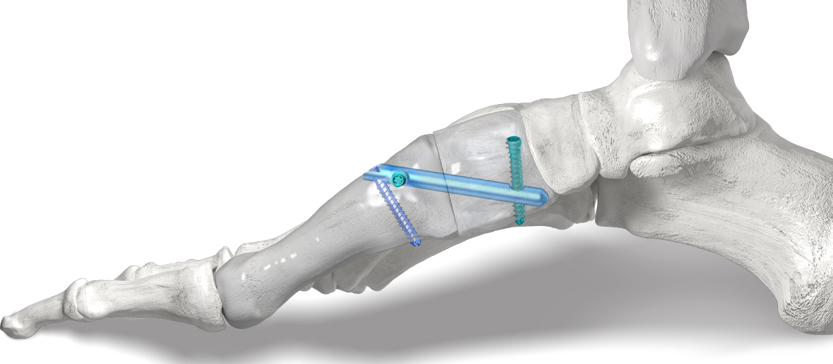 L3_Hole_Nail_Site2 Phantom® 3-Hole Intramedullary Nail