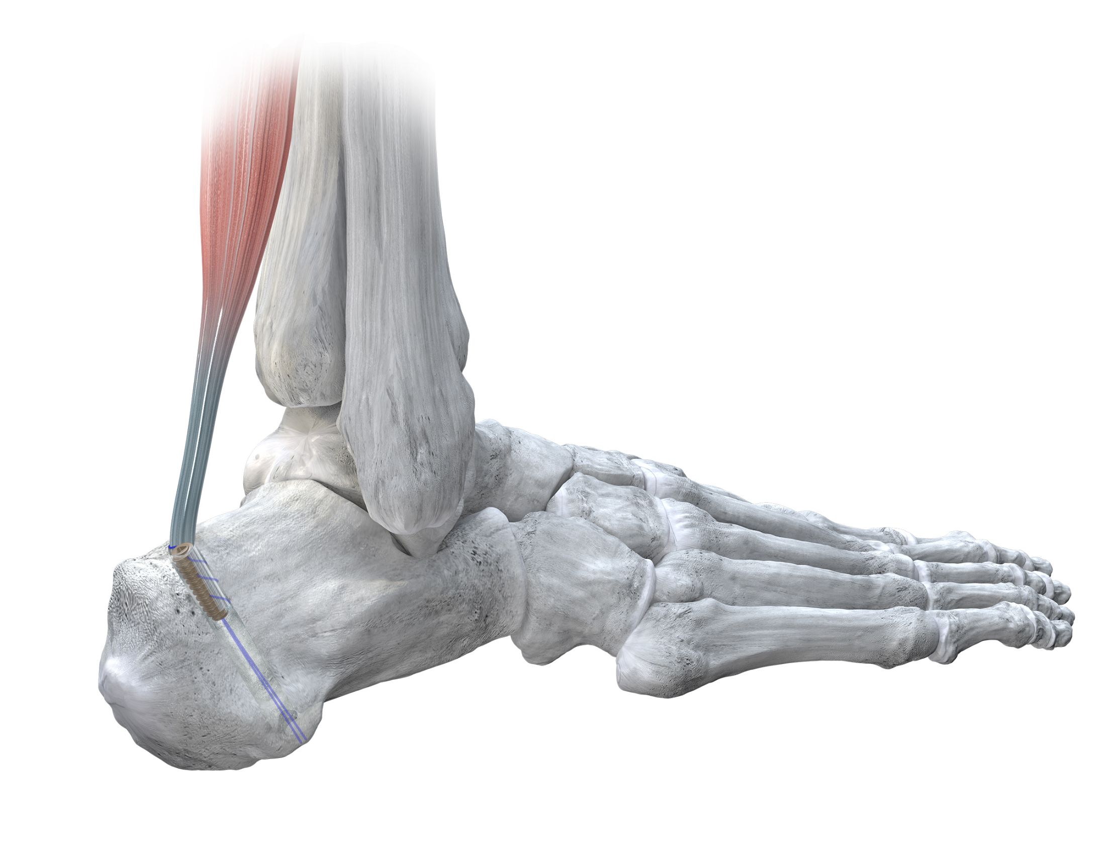Hero_Shot_FHL Interference Screw