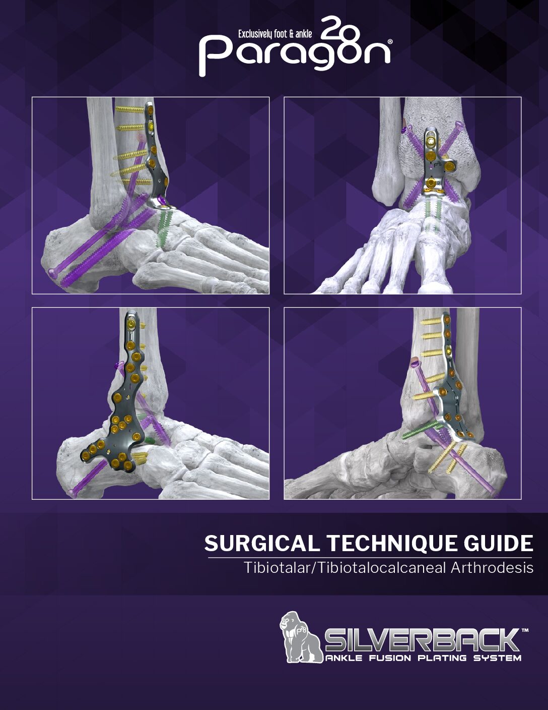 https://paragon.fru.qa/app/uploads/2020/01/P51-STG-0011-RevE_SilverbackAnkleFusionPlatingSystem_US-pdf.jpg