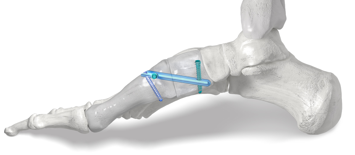 Lapidus_3_Hole_Nail Phantom® intramedullary nail