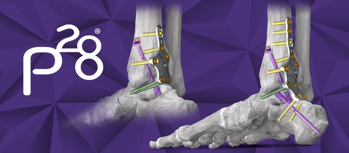 Silverback™ Ankle Fusion Plating System