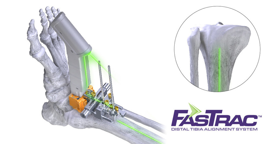 1-LinkedIn-Teaserdf-LinkedIn Paragon 28 FasTrac Distal Tibia Alignment System