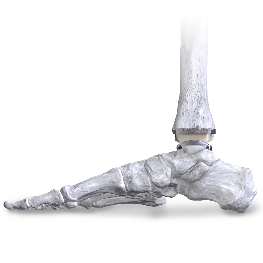 APEX TAR Medial Hero