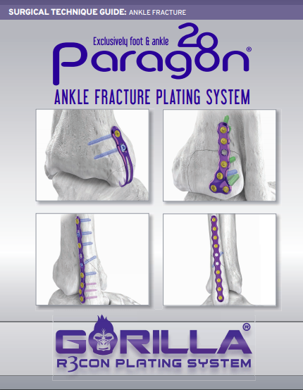 Ankle Fracture Plating System Surgical Technique Guide (CAN)