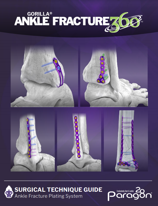 Ankle Fracture Plating System Surgical Technique Guide (US)
