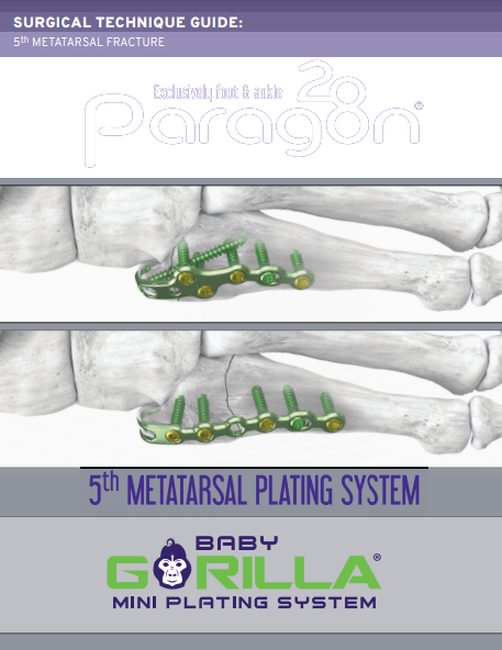 Baby Gorilla® 5th Metatarsal Plating System Surgical Technique Guide (US)