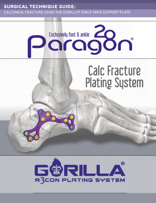 Calc Fracture Plating System Surgical Technique Guide (CAN)
