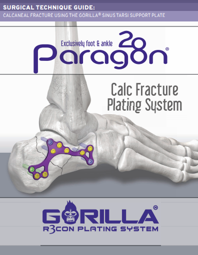 Calc Fracture Plating System Surgical Technique Guide (US)