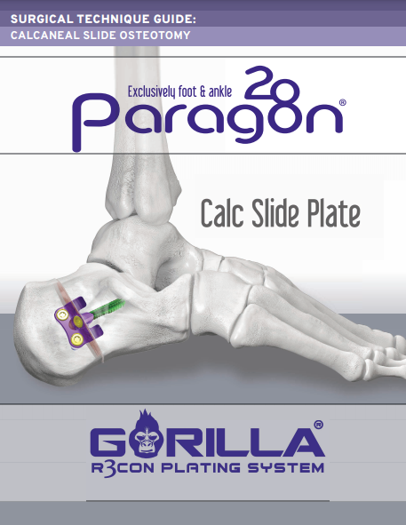 Calc Slide Plate Surgical Technique Guide (US)