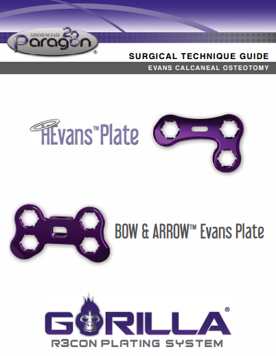 Evans Calcaneal Osteotomy Surgical Technique Guide (CE Marked)