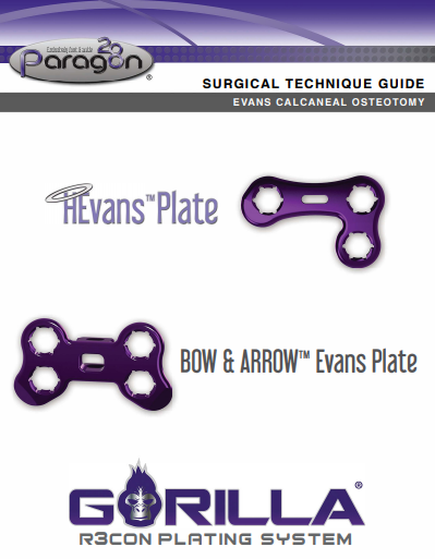 Evans Calcaneal Osteotomy Surgical Technique Guide (US)