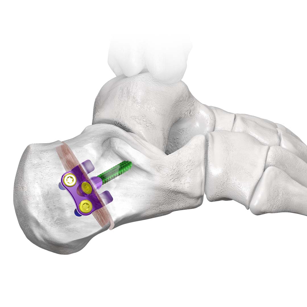 Gorilla Calc Slide Plate