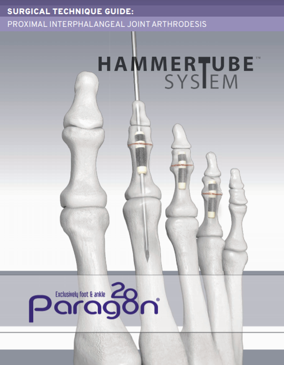 HammerTube™ System Surgical Technique Guide (CE Marked)