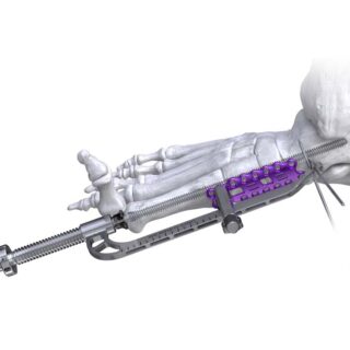 Joust Beaming Screws