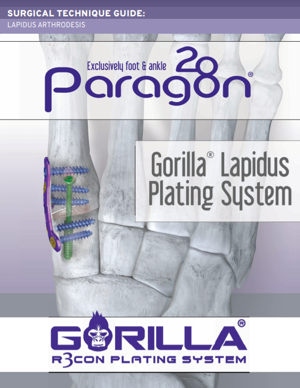Lapidus Arthrodesis Plating System Surgical Technique Guide (CE Marked)