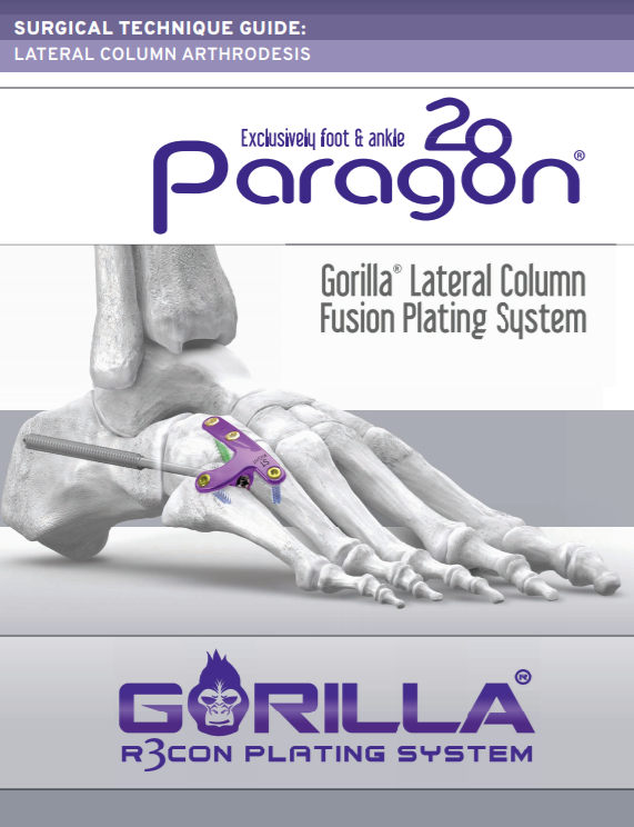 Lateral Column Plating System Surgical Technique Guide (CAN)
