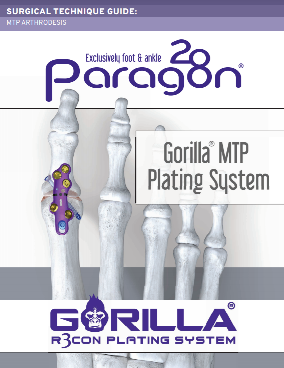 MTP Plating System Surgical Technique Guide (US)