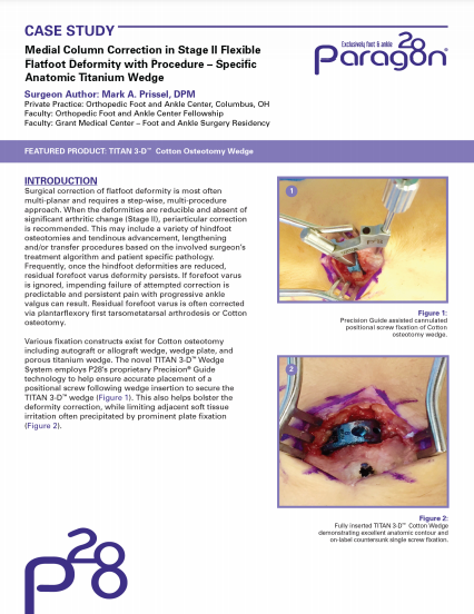 Medial Column Case Study