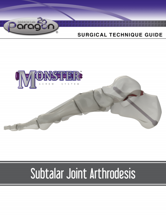 Monster® Subtalar Joint Arthrodesis Surgical Technique Guide (CE Marked)