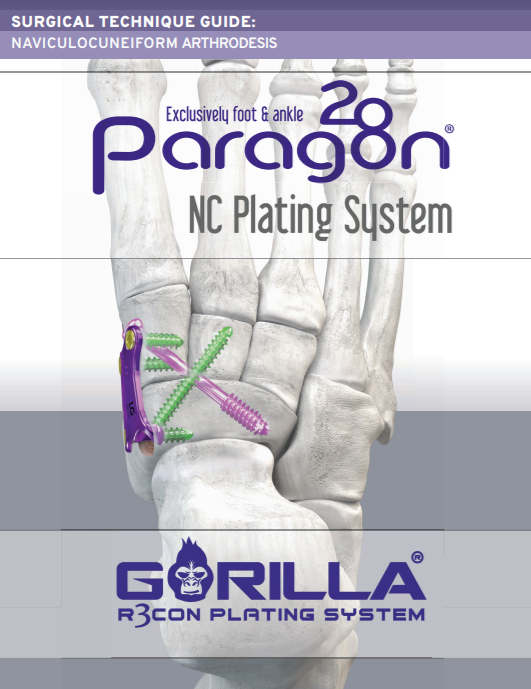 NC Fusion Plating System Surgical Technique Guide (US)