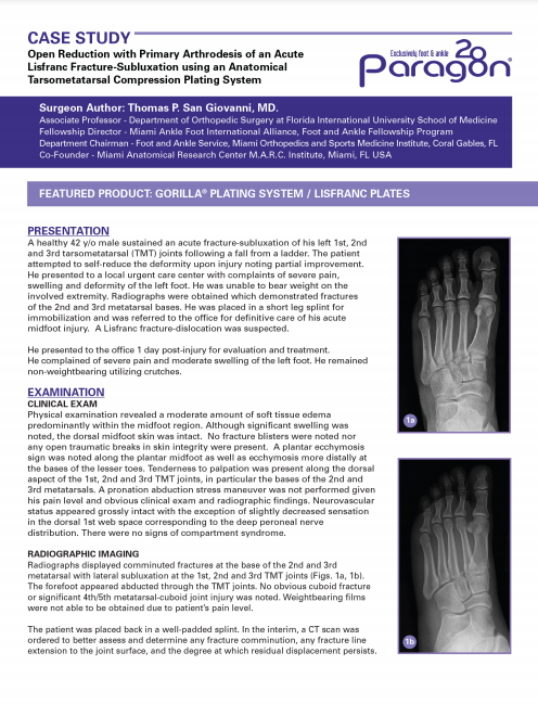 Open Reduction with Primary Arthrodesis of an Acute Lisfranc Fracture-Subluxation using an Anatomical Tarsometatarsal Compression Plating System