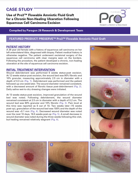 PRO3™-F Case Study