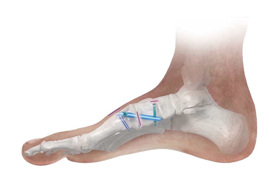 Phantom® Lapidus Intramedullary Nail