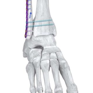 R3lease Screw On Bone Hero Image