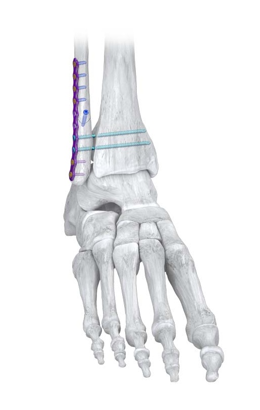 R3lease Screw On Bone Hero Image