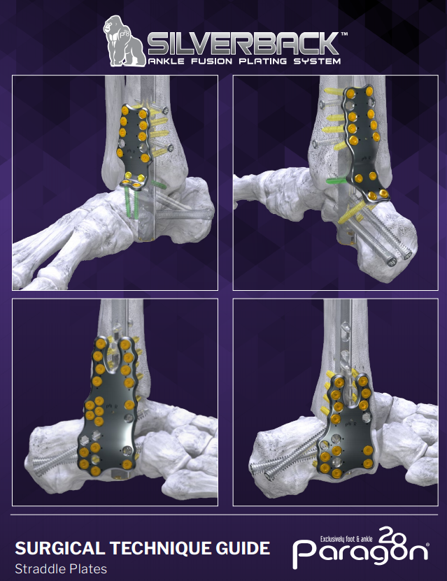 Silverback™ Straddle Ankle Fusion Plating System