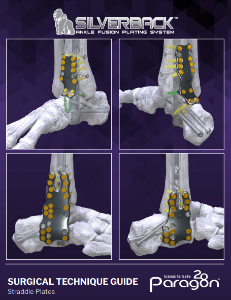Silverback™ Straddle Plate Surgical Technique Guide (US)