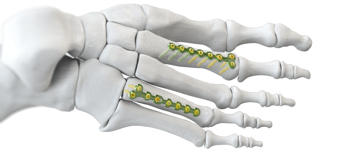 Baby Gorilla® T-Plates (Straight and Oblique)