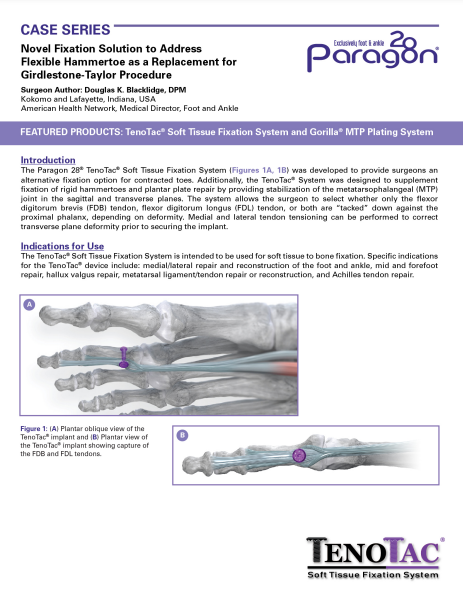 TenoTac™ Case Series – Contracted Toes, Plantar Plate Repair, and Hallux Contracture