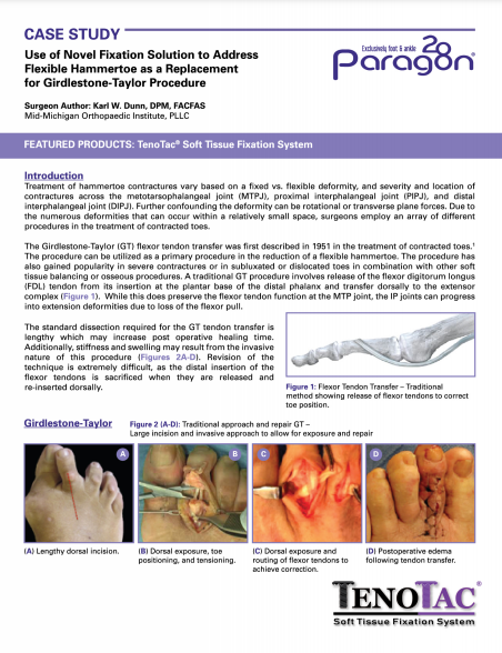 TenoTac™ Case Study – Use of Novel Fixation Solution to Address Flexible Hammertoe