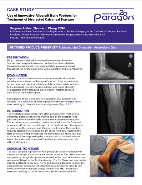 Use of Innovative Allograft Bone Wedges for Treatment of Neglected Calcaneal Fracture