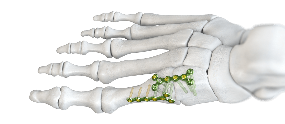 Baby Gorilla® Y-Plates (Single and Double)